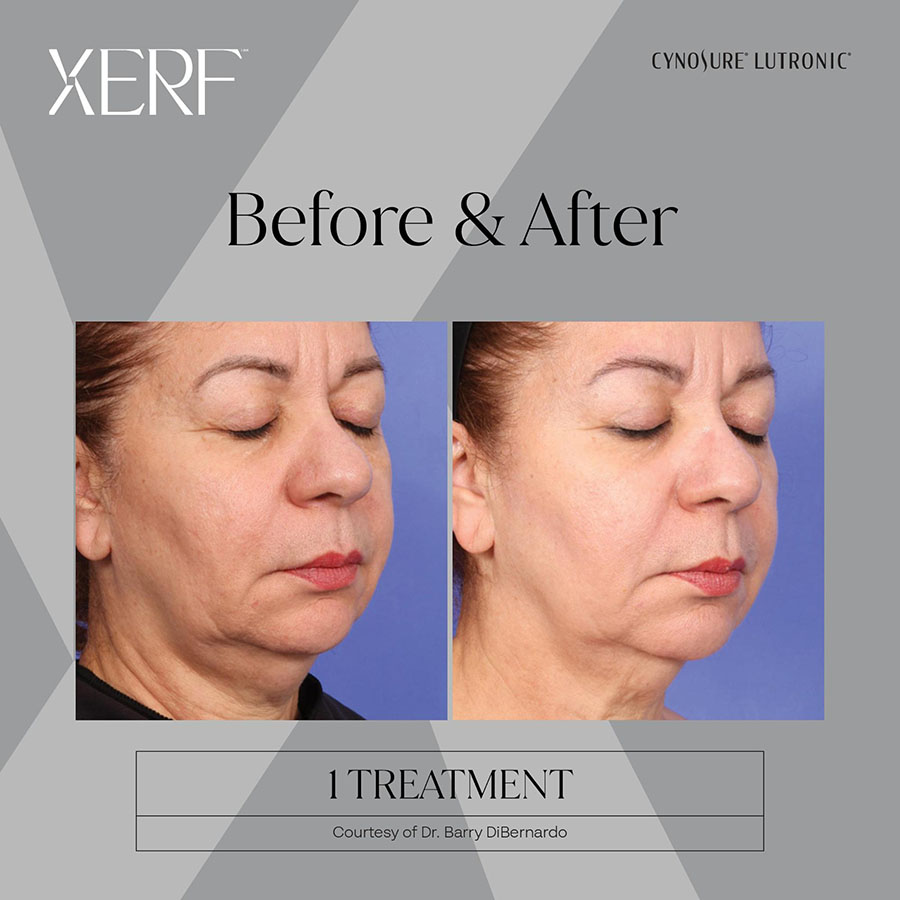 Before and After 2 Treatments – Courtesy of Dr. Dianne Quibell.