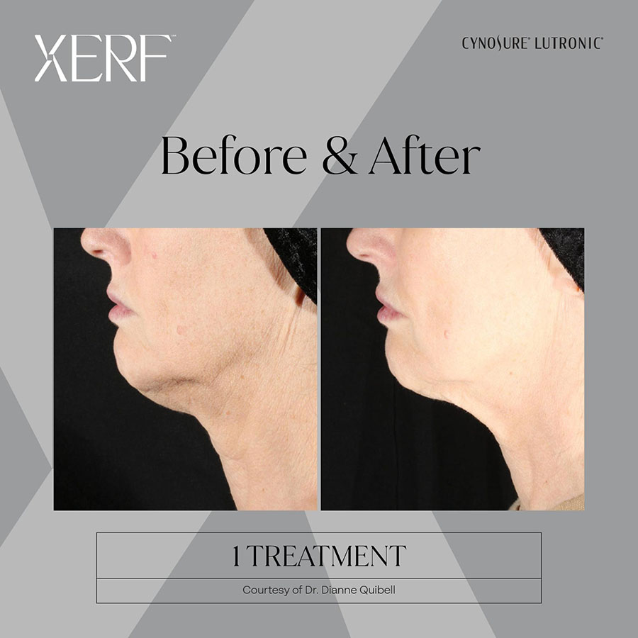 Before and After 1 Treatments – Courtesy of Dr. Dianne Quibell.
