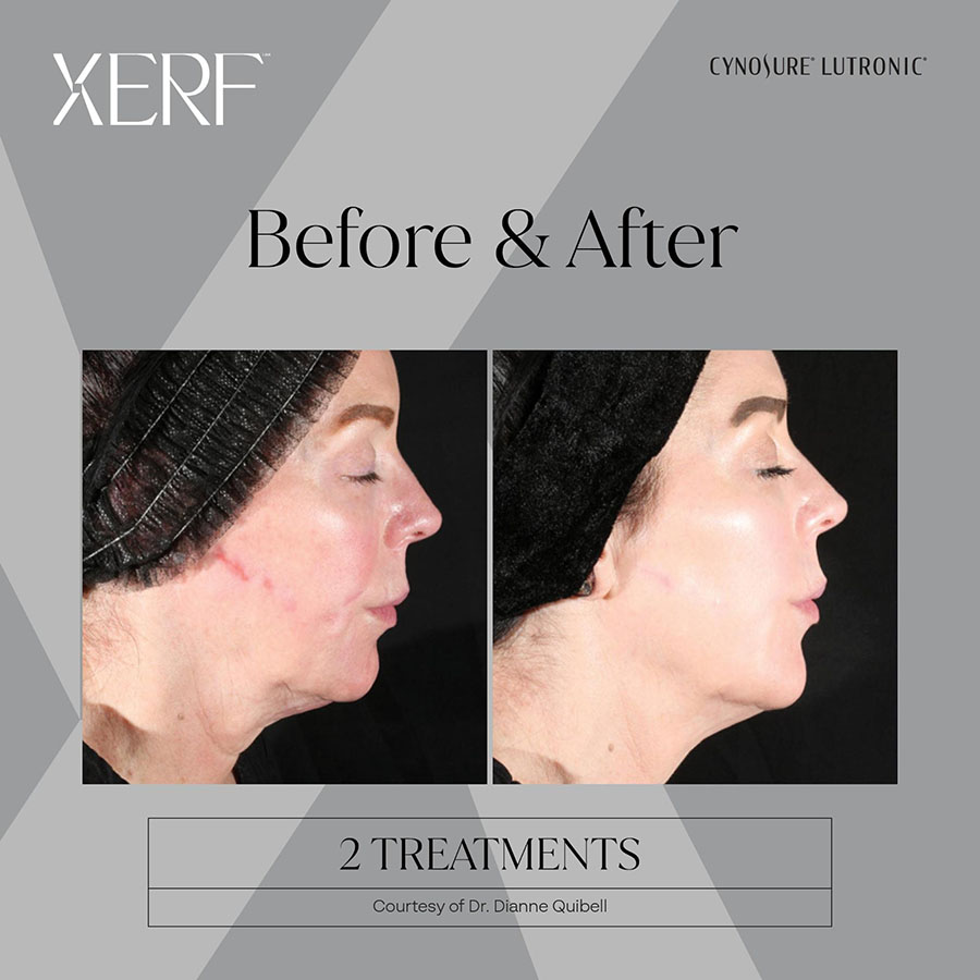 Before and After 3 Treatments – Courtesy of Dr. Dianne Quibell.