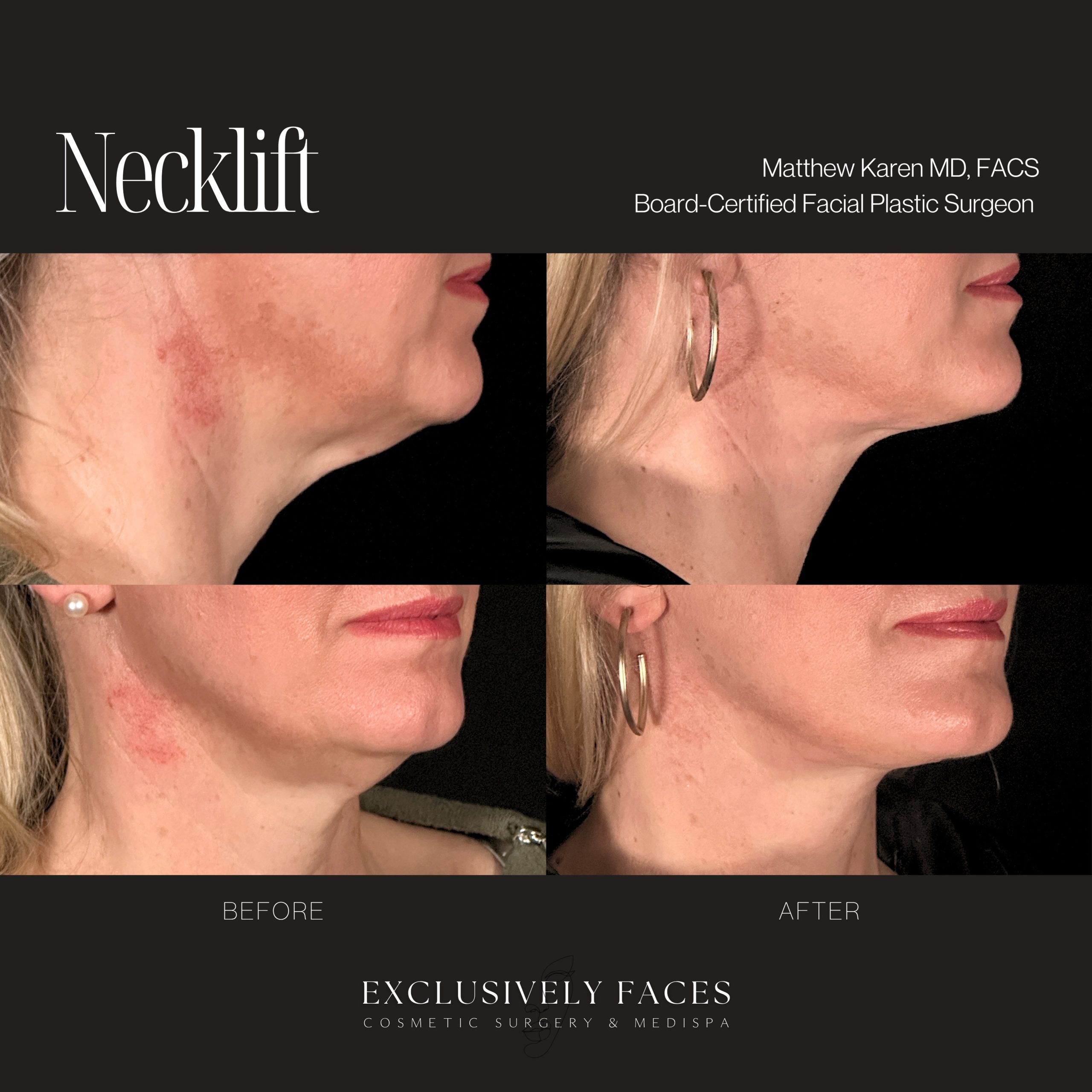 A beautifully refined neck contour with a smoother, more defined jawline. This neck lift result demonstrates how subtle, strategic changes can create a more youthful and balanced profile while maintaining a natural appearance. Performed by Board-Certified Facial Plastic Surgeon Dr. Matthew Karen. . . #necklift #beforeandafter #neckliftresults #facialplasticsurgery