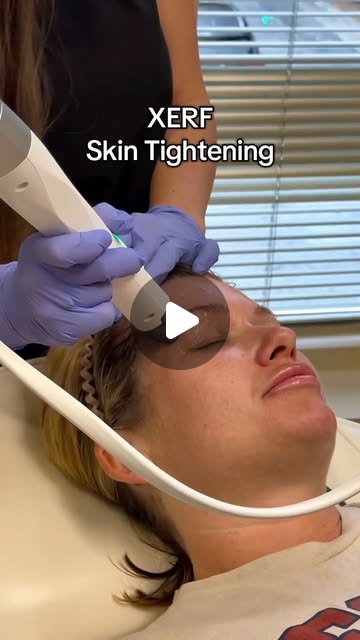 Everybody is loving XERF—Dr. Karen included XERF sets a new standard for non-invasive skin tightening. This next-generation radiofrequency treatment delivers energy deeper and with more precision than traditional RF. The result is smoother, tighter, more lifted skin—without numbing, needles, or downtime. . . #xerf #rf #skintightening #skintreatment #antiaging #medspa #peachtreecity